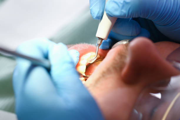 Best Emergency Tooth Extraction in Bemidji, MN